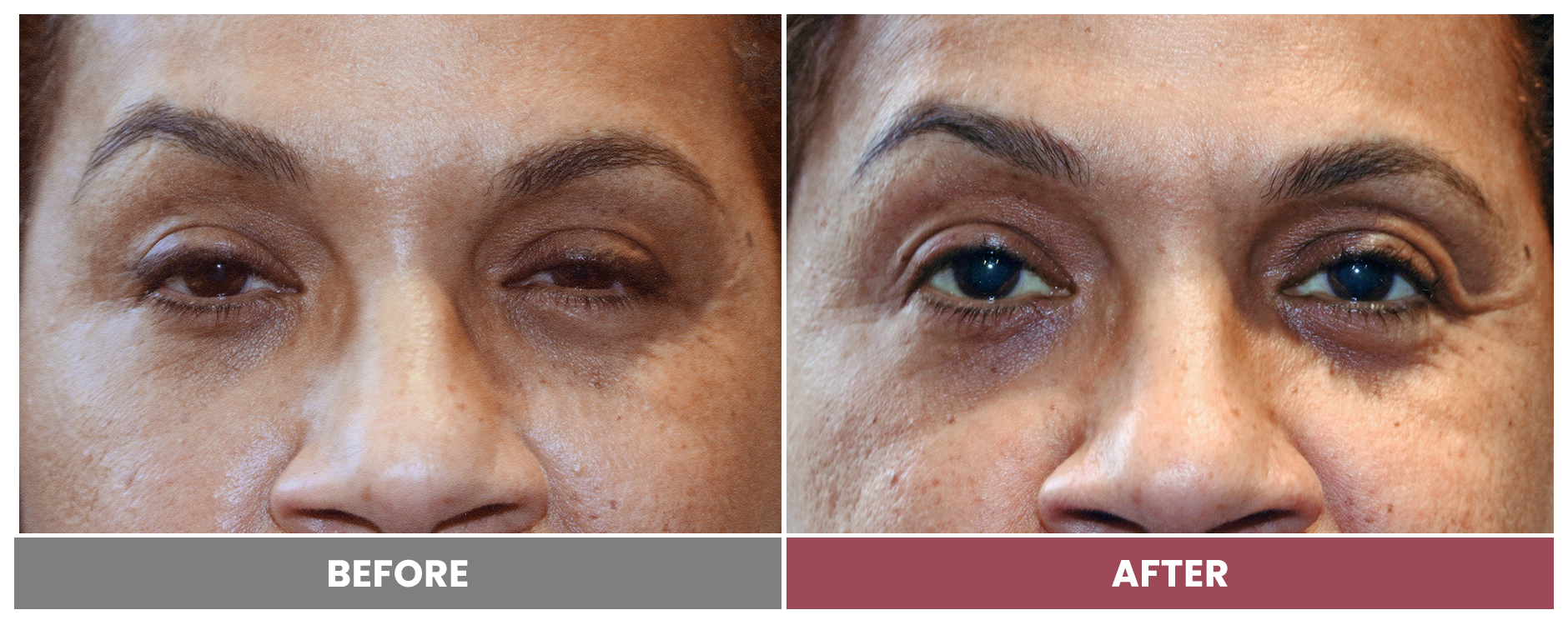 PTOSIS REPAIR - Case 70